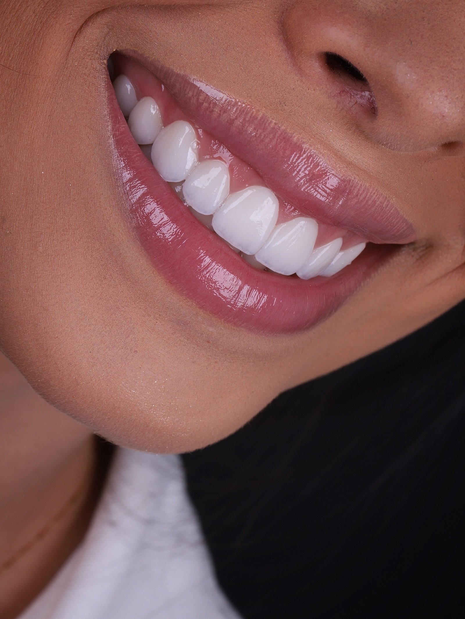 Detalhe de sorriso tratado